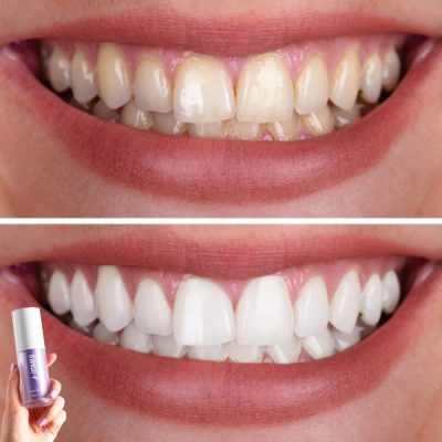 JOYTEETH14745__220525-400x400__310725